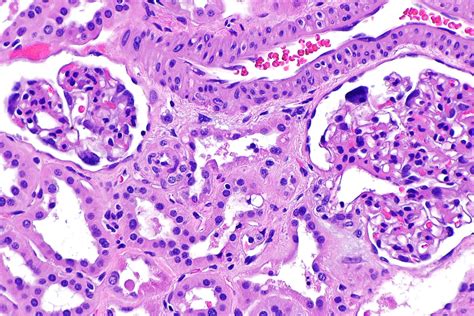 Rare Disease Day - Cystinosis | Doctor-4-U