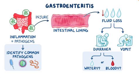 Gastroenteritis :The Top 5 Foods to Avoid - Facts Full