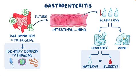 Infectious gastroenteritis: Clinical sciences - Osmosis Video Library