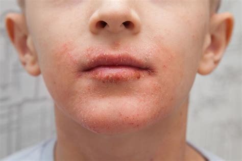 Dry skin around the mouth: Causes, treatment, and remedies