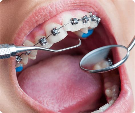 Dental Braces in Sri Lanka | Orthodontists in Colombo