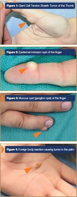 Hand & Wrist Tumors, White Plains | Ganglion Cyst, New York