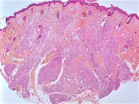 Skin Hemangioma Histology