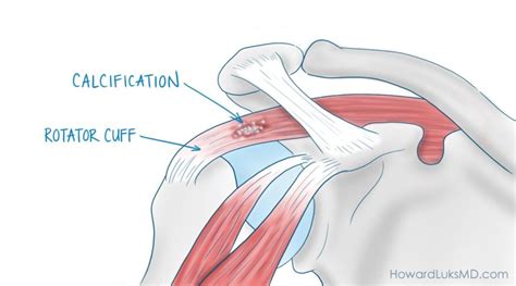 Shoulder Pain When Lifting The Arm : Causes and Cures – Howard J. Luks, MD