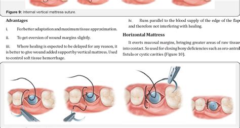 [PDF] Dental Suturing Materials and Techniques | Semantic Scholar