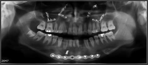 Routine Screening Radiography for Retained Wire Following Arch Bar Removal Is Not Indicated ...