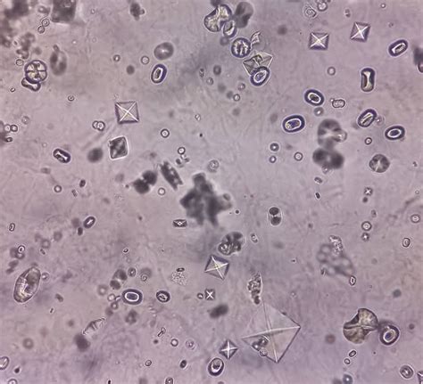 Calcium Oxalate Kidney Stones Microscope