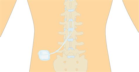 Spinal-Cord Stimulator Implants - Seattle, WA - Brain and Spine Surgery