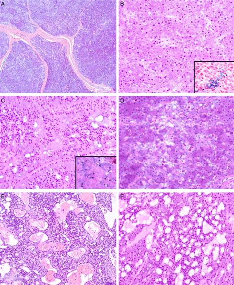 Histologic spectrum of salivary gland acinic cell carcinoma with ...