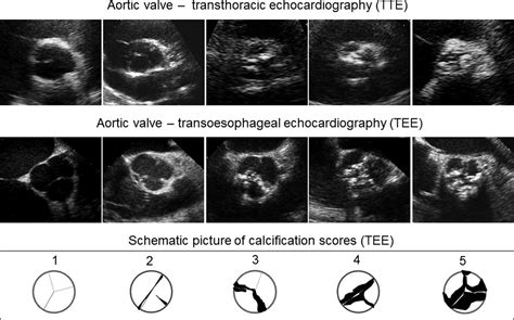 Aortic Valve Echo