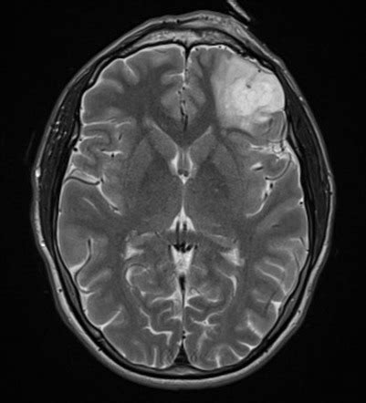 Anaplastic oligodendroglioma | Radiology Reference Article | Radiopaedia.org