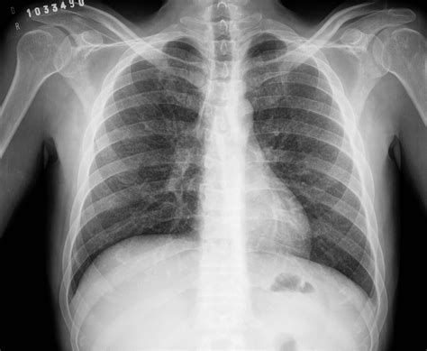 Miliary tuberculosis | Image | Radiopaedia.org