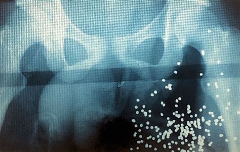 Shotgun wound to the left groin | Trauma Surgery & Acute Care Open