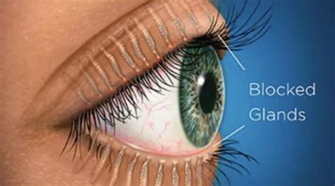 What is Meibomian Gland Dysfunction? - Dry Eye Care Texas