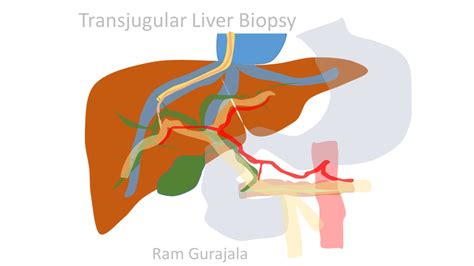 Transjugular Liver Biopsy (TJLBx) | IR 4 U