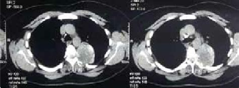 Posterior mediastinal mass with features of malignant neurogenic tumor ...