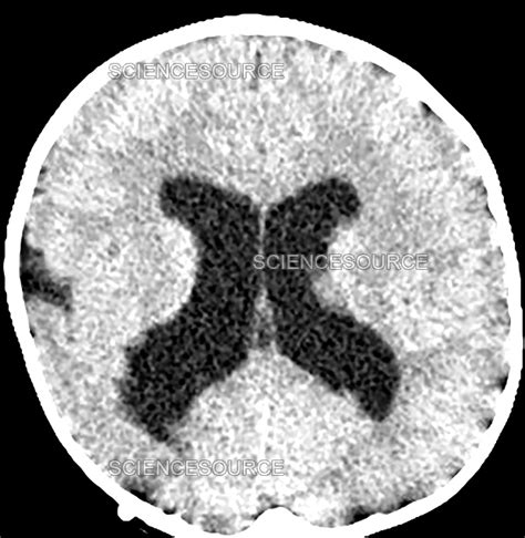 Schizencephaly, CT scan | Stock Image - Science Source Images