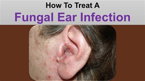 How To Treat A Fungal Ear Infection - YouTube