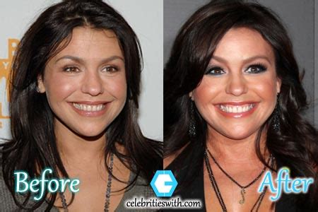 Rachael Ray Plastic Surgery, Before and After Botox Photos ...