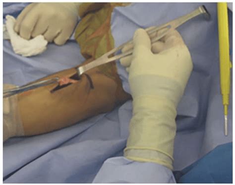 One-Incision Distal Biceps Tendon Repair | Musculoskeletal Key