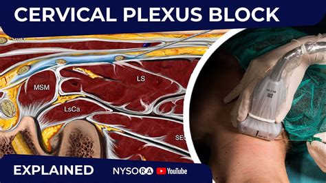 Ultrasound-Guided Cervical Plexus Block, 51% OFF