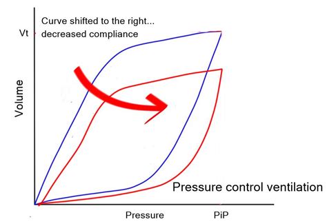 Mechanical Ventilation Series- Pressure/Volume loop….. - Critical Care Practitioner