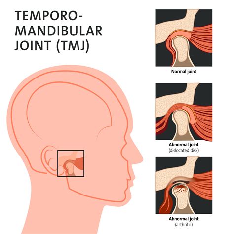 Temporomandibular Joint (TMJ) Disorders- Symptoms, Causes, 53% OFF