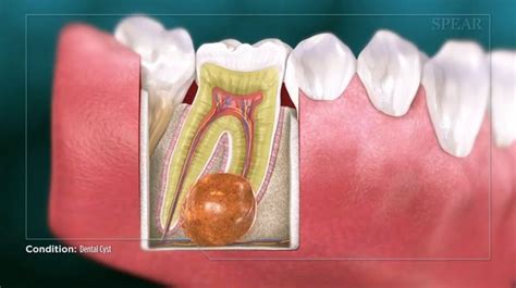 Tooth Eruption Cyst