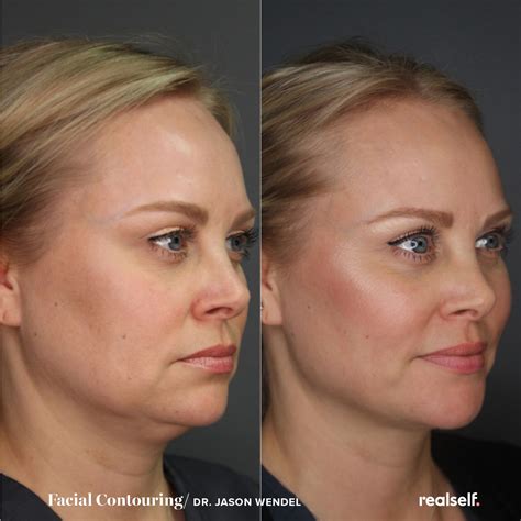 Double Chin | Double chin, Double chin surgery, Kybella double chin