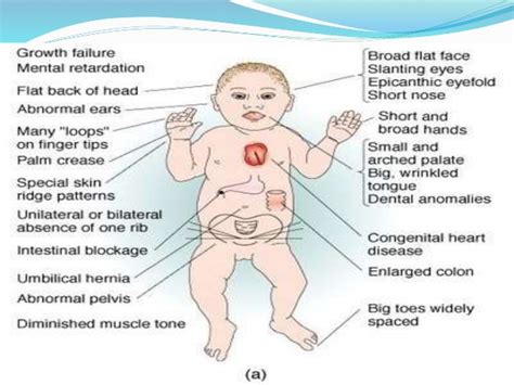 Patau Syndrome - Plastic surgery in Istanbul