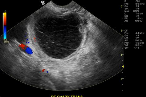 Haemorrhagic ovarian cyst | Image | Radiopaedia.org