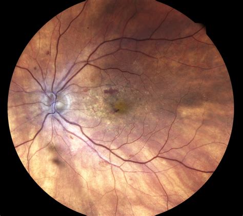 OCT angiography | Retina & Eidon