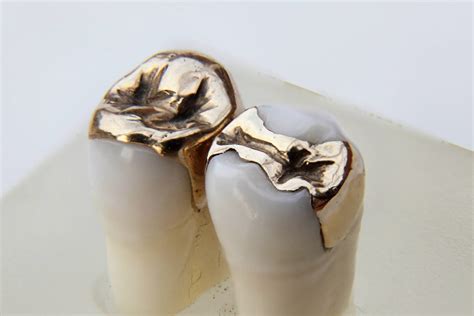 What Are Dental Inlay and Onlay? - GlobalDentalPro