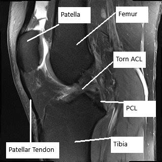 Case Study: Meniscal Injury Management in 30 yr. Old Female