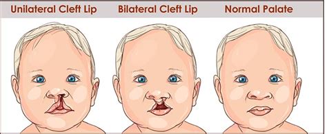 Cleft Lip - Cleft & Craniofacial Institute of Utah