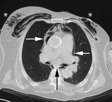 Subcutaneous emphysema and tension pneumomediastinum | Emergency Medicine Journal