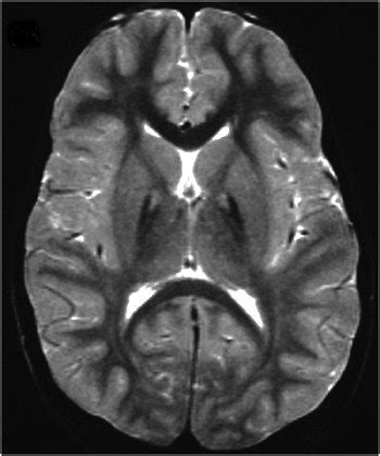 MRI advances diagnosis of Hallervorden-Spatz syndrome | AuntMinnie