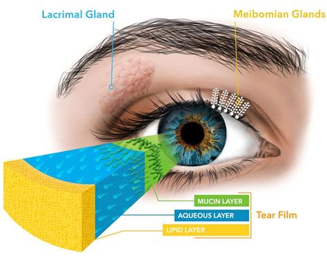 Meibomian Gland Dysfunction Treatment in Nappanee IN