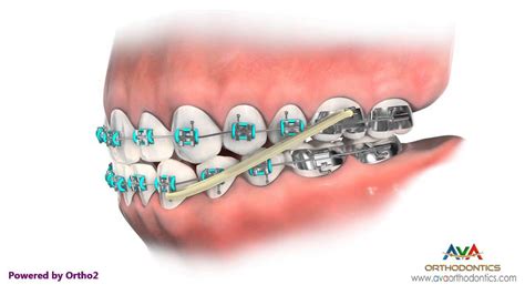 Crossbite (AKA Underbite) Treatment by Rubber Bands - Orthodontic Instruction - YouTube