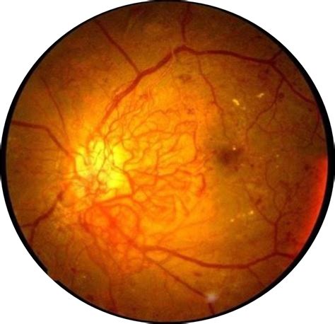 FAQ - ERIE RETINAL SURGERY