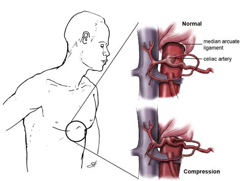 Celiac Artery Compression Syndrome - Symptoms | Health Secrets and Tips