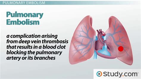 Pulmonary Embolism Causes