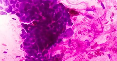 Undifferentiated Pleomorphic Sarcoma: Causes, Symptoms and Treatment