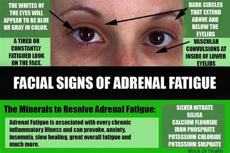 The Facial Signs of Adrenal Fatigue #chronicfatiguediagnosis #Therightdietformythyroid | Signs ...