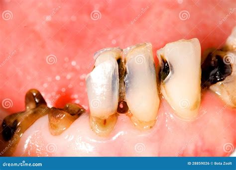 Tooth Caries Royalty Free Stock Image - Image: 28859026