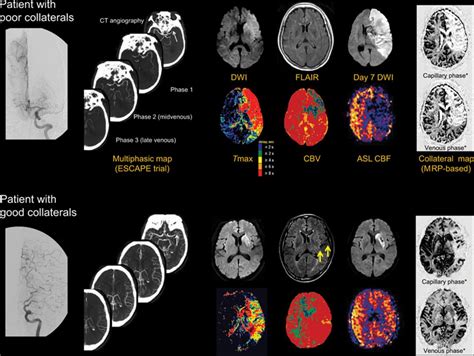 Collateral Circulation in Ischemic Stroke | Stroke