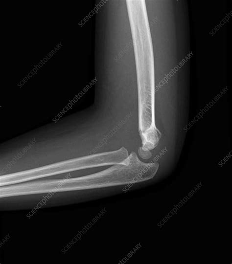 Supracondylar fracture, X-ray - Stock Image - F036/0247 - Science Photo ...