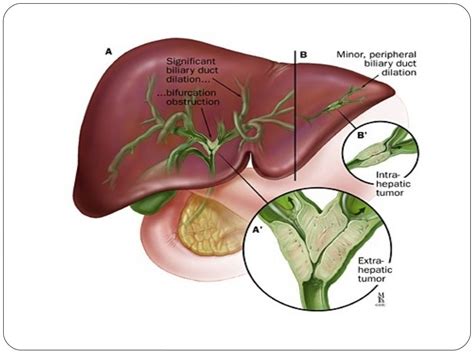 Clonorchiasis sinensis