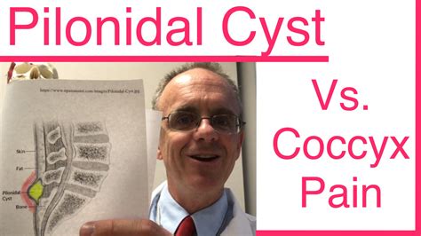 Is a PILONIDAL CYST Causing Your Tailbone Pain, Coccyx Pain? | Tailbone Doctor