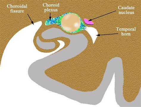 Choroidal fissure cyst | Eurorad